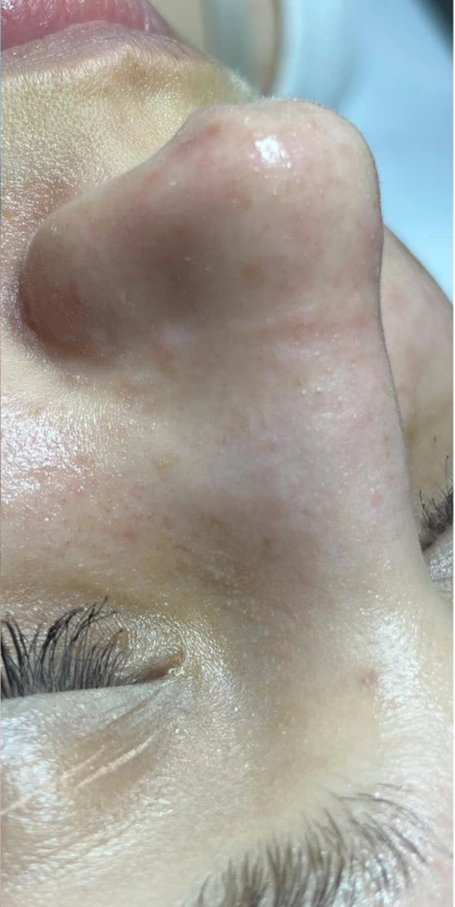 Skóra po zabiegu oczyszczania wodorowego